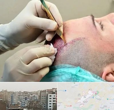 کلینیک کاشت مو در محمد شهر کرج