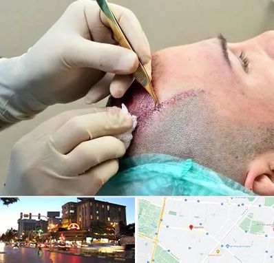 کلینیک کاشت مو در بلوار سجاد مشهد