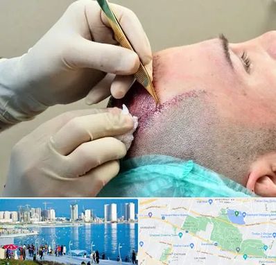 کلینیک کاشت مو در چیتگر