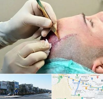 کلینیک کاشت مو در شریعتی مشهد