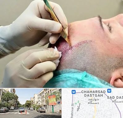 کلینیک کاشت مو در چهارصد دستگاه
