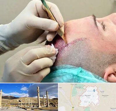 کلینیک کاشت مو در مرودشت