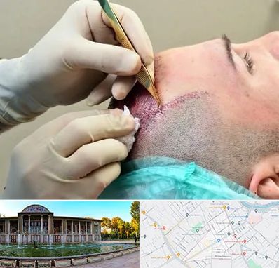 کلینیک کاشت مو در عفیف آباد شیراز