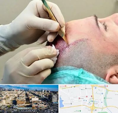 کلینیک کاشت مو در شهرک راه آهن