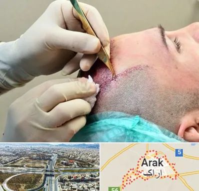 کلینیک کاشت مو در اراک