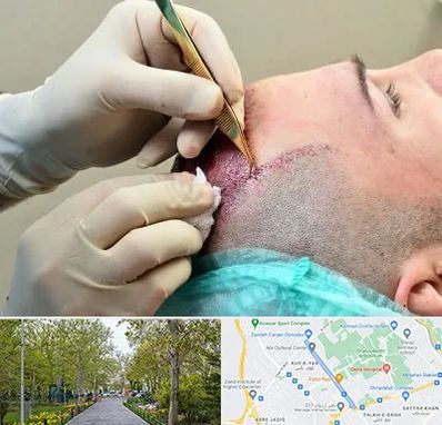 کلینیک کاشت مو در قدوسی غربی شیراز