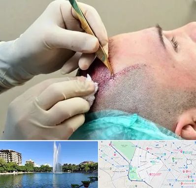 کلینیک کاشت مو در کوهسنگی مشهد