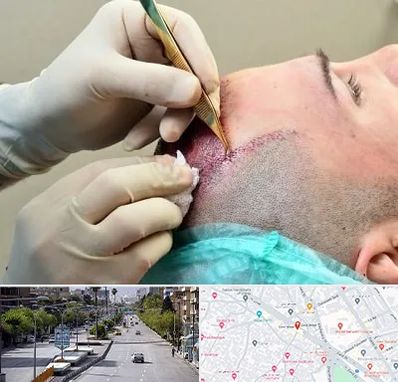 کلینیک کاشت مو در خیابان زند شیراز