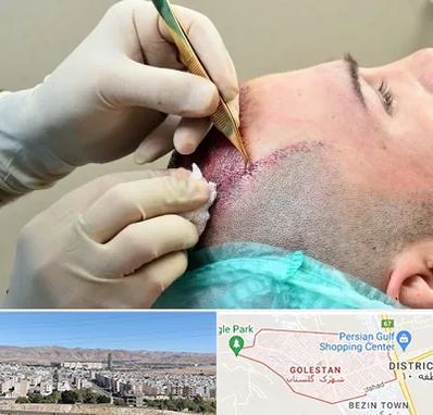 کلینیک کاشت مو در شهرک گلستان شیراز