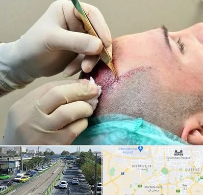 کلینیک کاشت مو در جنوب تهران