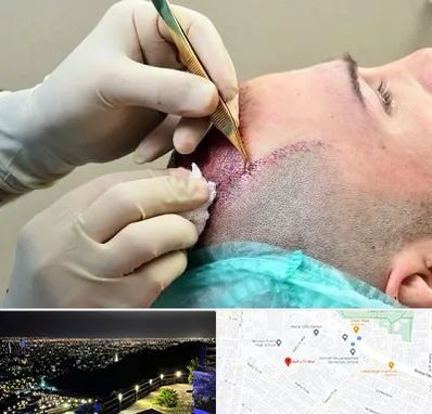 کلینیک کاشت مو در هفت تیر مشهد