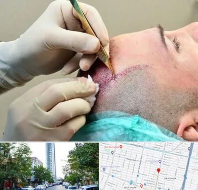 کلینیک کاشت مو در امامت مشهد