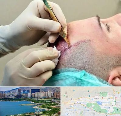 کلینیک کاشت مو در منطقه 22 تهران