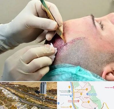 کلینیک کاشت مو در خیابان نیایش شیراز