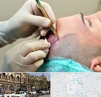 کلینیک کاشت مو در منطقه 11 تهران