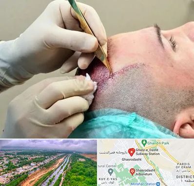 کلینیک کاشت مو در قصرالدشت شیراز