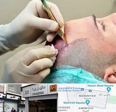 کلینیک کاشت مو در منیریه