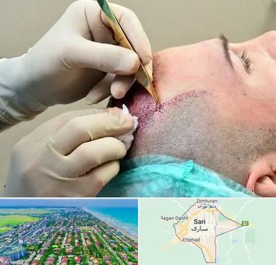کلینیک کاشت مو در ساری