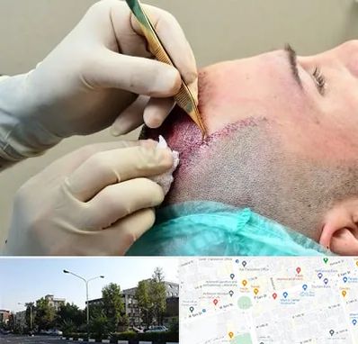 کلینیک کاشت مو در میدان کاج