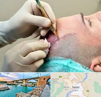 کلینیک کاشت مو در دزفول