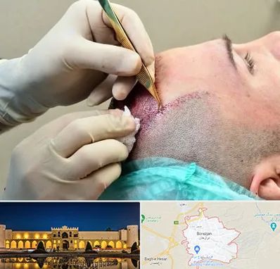 کلینیک کاشت مو در برازجان