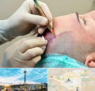 کلینیک کاشت مو در تهران