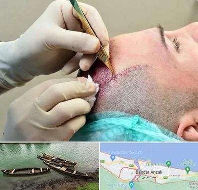 کلینیک کاشت مو در بندر انزلی