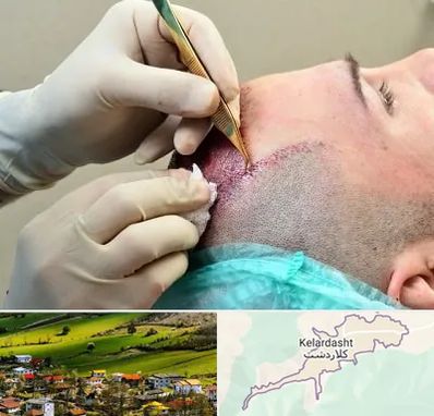 کلینیک کاشت مو در کلاردشت