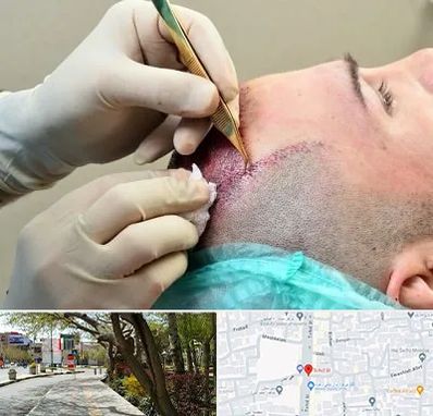 کلینیک کاشت مو در خیابان توحید اصفهان