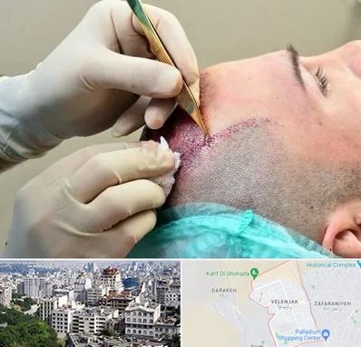 کلینیک کاشت مو در ولنجک