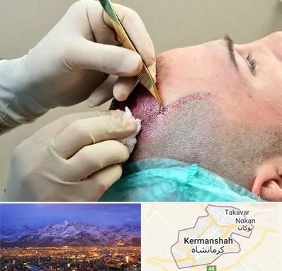 کلینیک کاشت مو در کرمانشاه