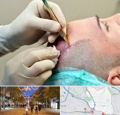 کلینیک کاشت مو در ولیعصر ارومیه