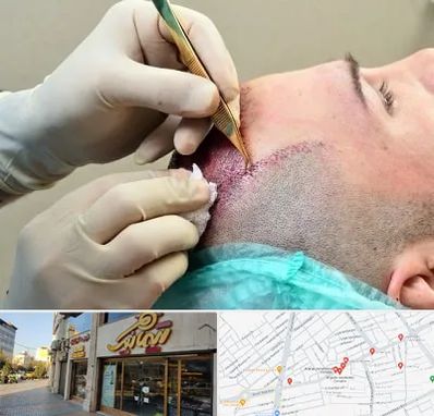 کلینیک کاشت مو در عطاران قم