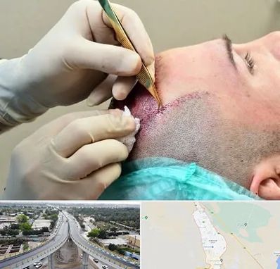 کلینیک کاشت مو در اندیمشک