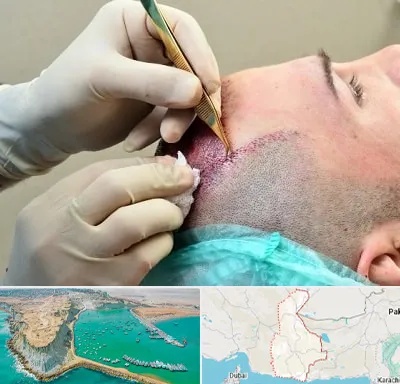 کلینیک کاشت مو در سیستان و بلوچستان