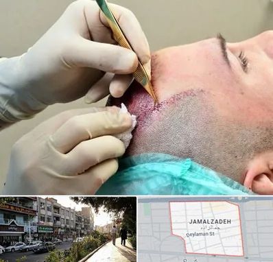 کلینیک کاشت مو در خیابان جمالزاده