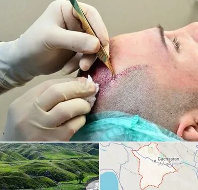 کلینیک کاشت مو در گچساران