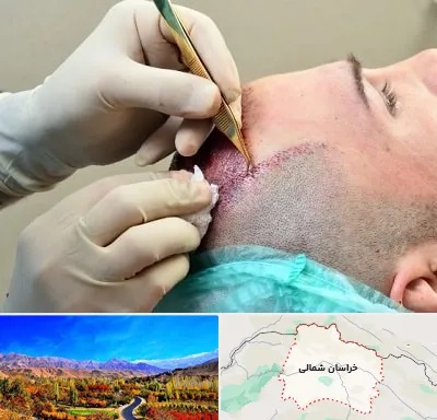 کلینیک کاشت مو در خراسان شمالی