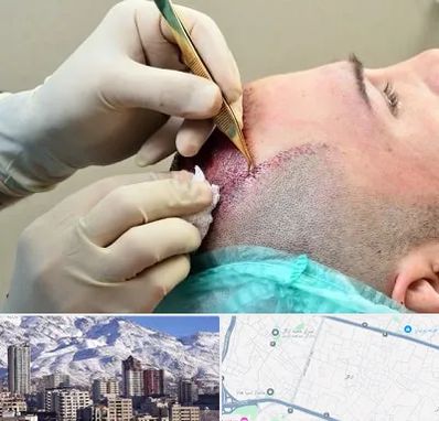 کلینیک کاشت مو در ازگل