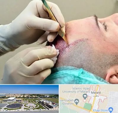 کلینیک کاشت مو در ملارد