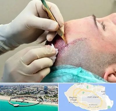 کلینیک کاشت مو در کیش