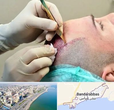 کلینیک کاشت مو در بندرعباس