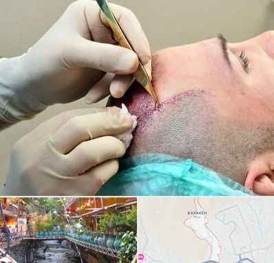 کلینیک کاشت مو در درکه