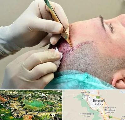 کلینیک کاشت مو در بروجرد