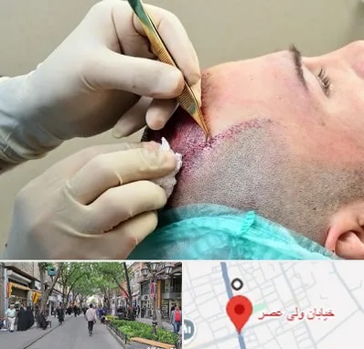 کلینیک کاشت مو در ولیعصر شهریار