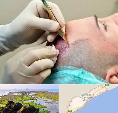 کلینیک کاشت مو در بندرلنگه