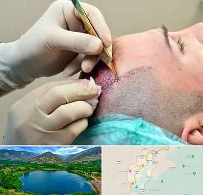 کلینیک کاشت مو در رودبار