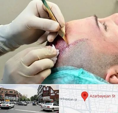 کلینیک کاشت مو در خیابان آذربایجان