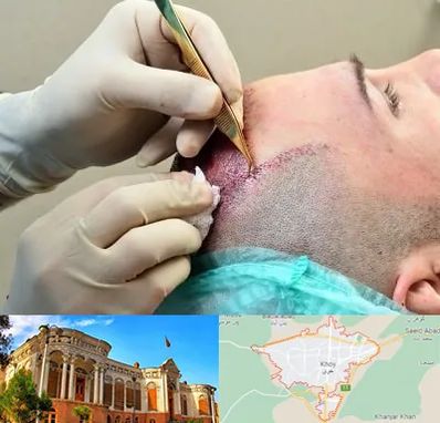 کلینیک کاشت مو در خوی