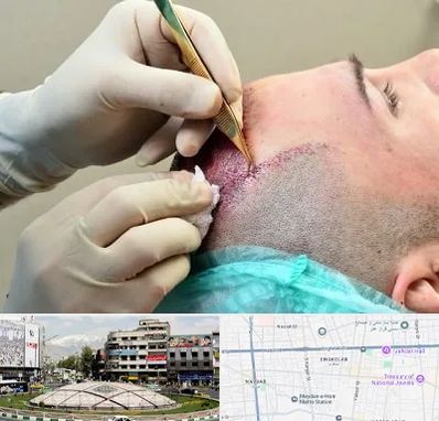 کلینیک کاشت مو در مرکز تهران